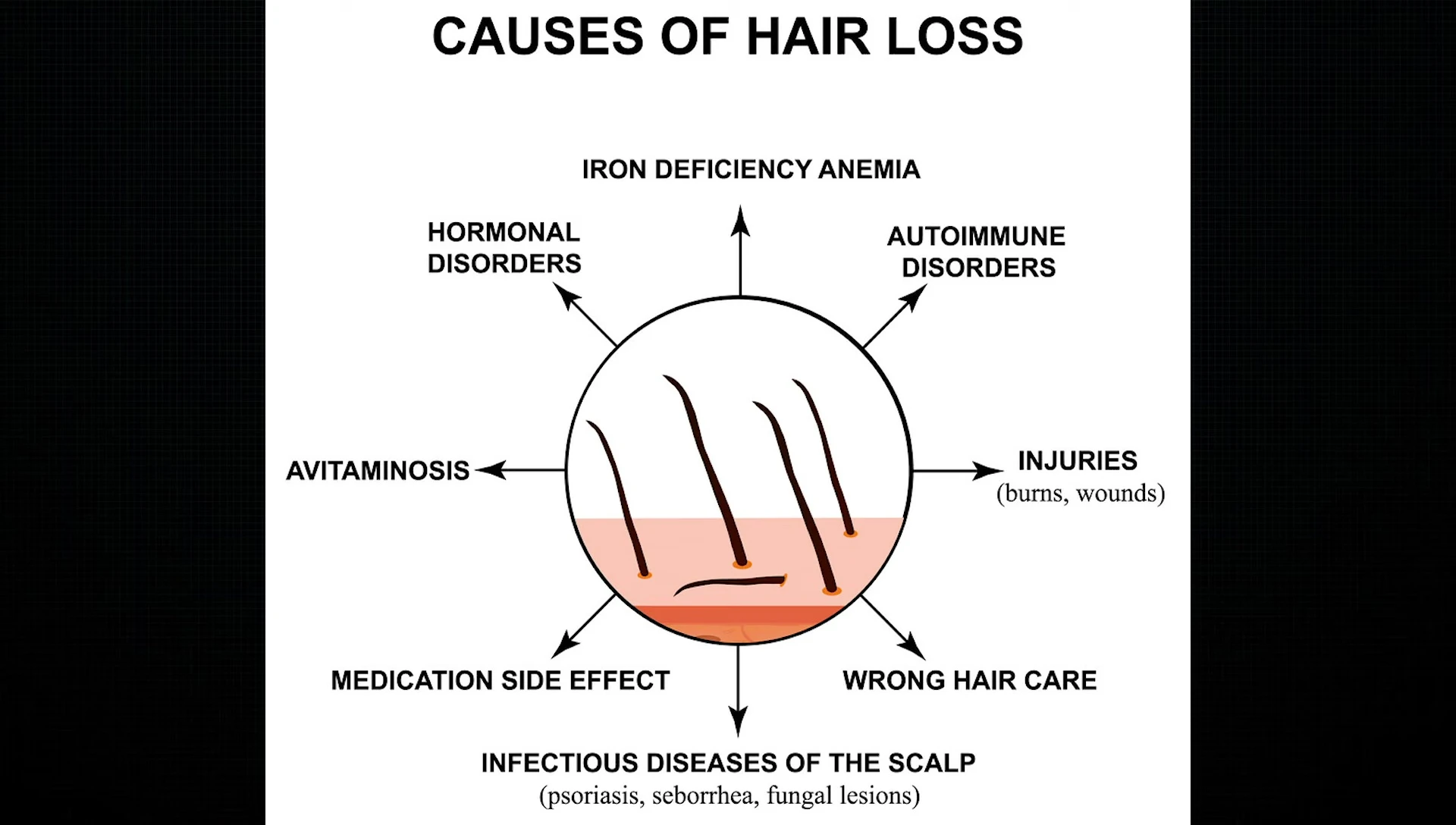 Image illustrating various factors contributing to hair loss.
